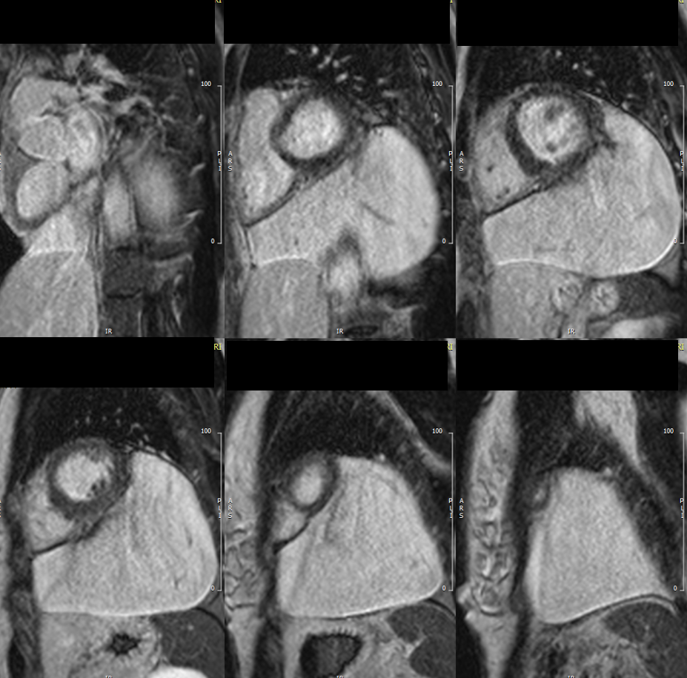 TAQUICARDIA VENTRICULAR