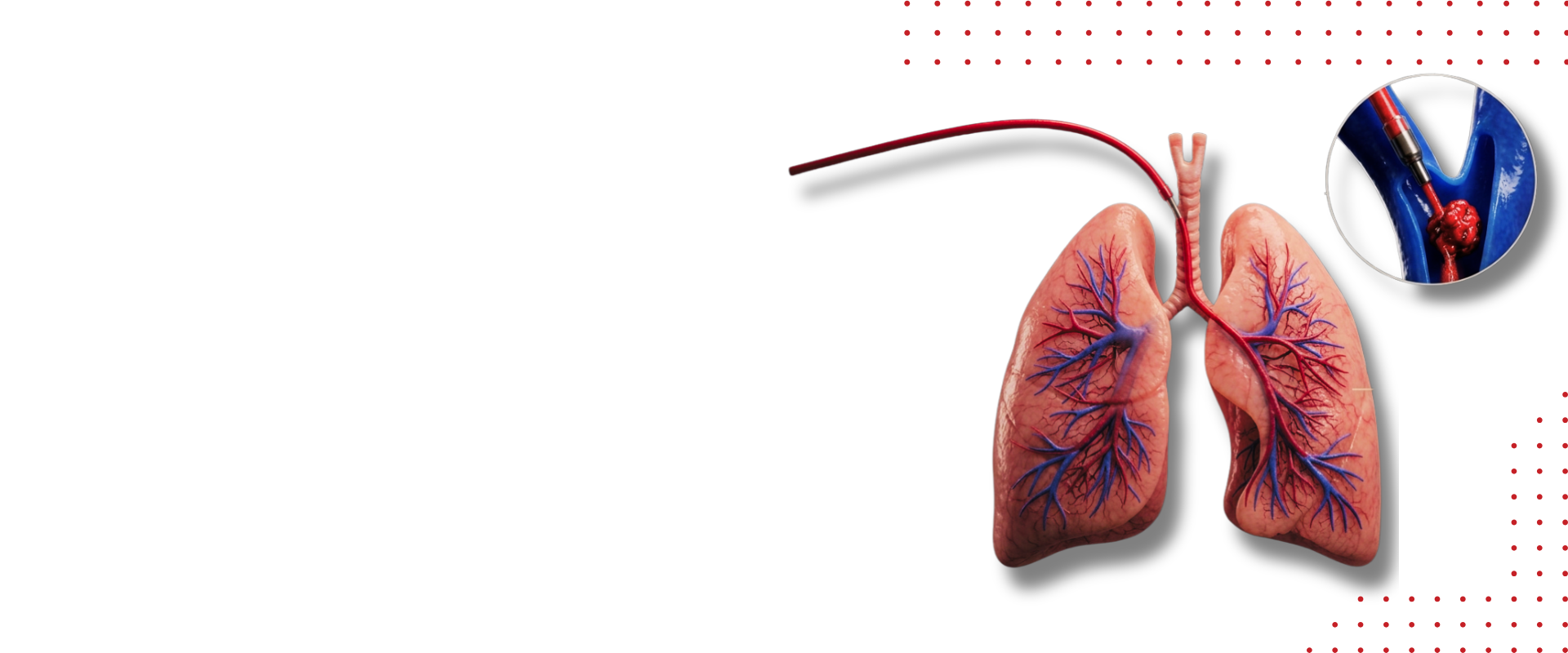 HI-PEITHO: Redefiniendo la reperfusión en la tromboembolia pulmonar de riesgo intermedio-alto